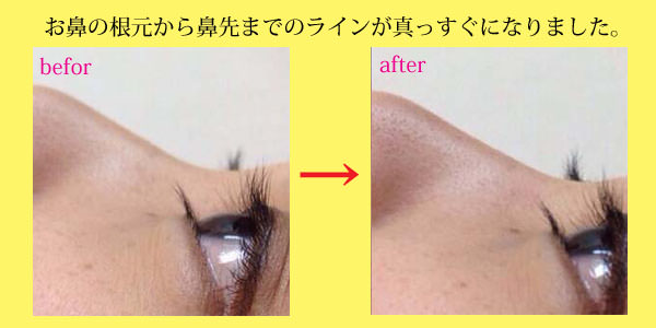 隆鼻矯正の施術例：鼻のラインが真っすぐに