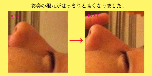 隆鼻矯正の施術例：鼻の根元がはっきりと高く