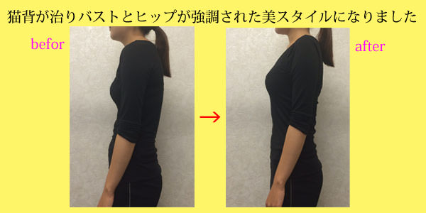 姿勢矯正の施術例：猫背改善で美スタイルに